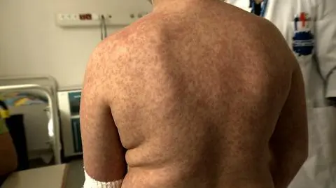 Doktor Paweł Grzesiowski w "Faktach o Świecie" TVN24 BiS