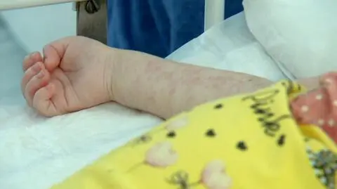 Ostrzeżenia WHO właśnie stały się faktem. Liczba zachorowań na odrę rośnie lawinowo