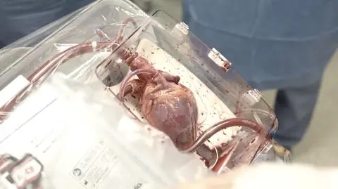 To urządzenie zrewolucjonizuje transplantologię serca w Polsce. "Kończy się epoka lodowcowa"