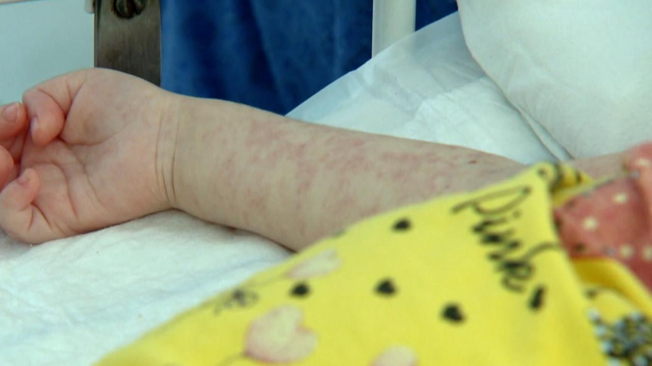 UNICEF: populacja Polski straciła zbiorową odporność na odrę. Powód to niska wyszczepialność