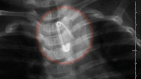13.02.2020 | Niemowlę połknęło agrafkę, do szpitala pojechało autem rodziców. Są zarzuty dla lekarki