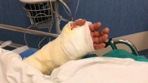 28.02.2017 | Wrocław: chirurdzy przeszczepili dłoń 32-latkowi. Pacjent urodził się bez ręki